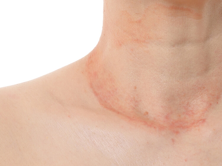 アトピー性皮膚炎による首まわりの症状イメージ