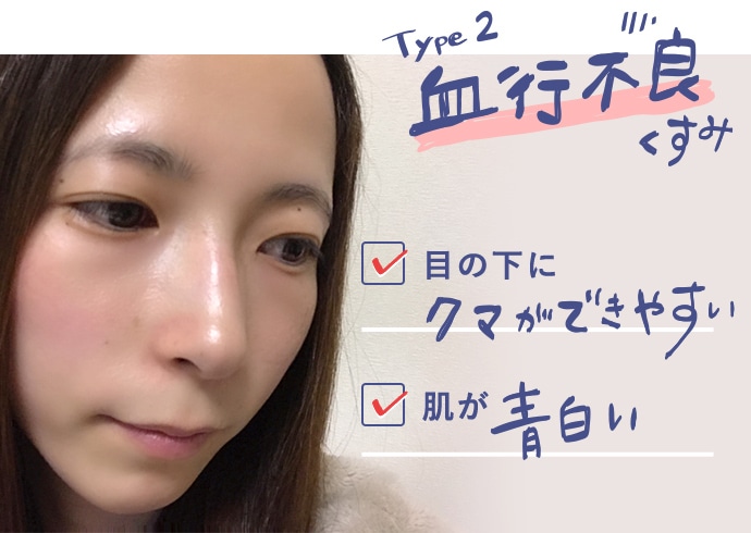 TYPE2血行不良くすみ　目の下にクマができやすい　肌が青白い